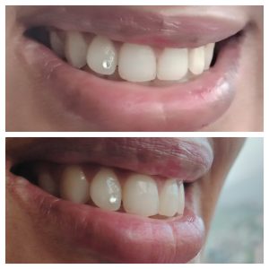 Dimond ( Tooth Zem )