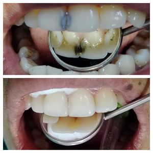 Composite Restoration