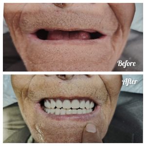 CD ( Complete Denture)