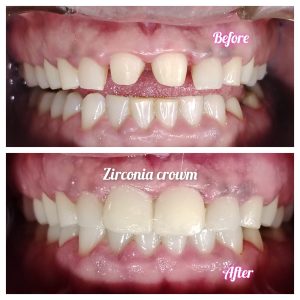 Zirconia Crown ( Smile enhance)