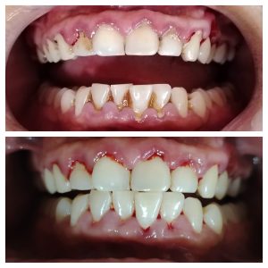 Sub & Supra Gingival Scaling
