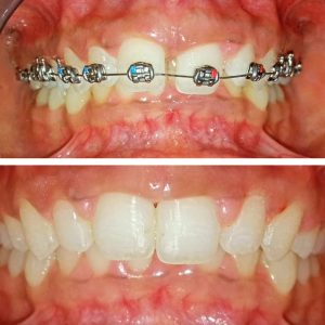 Braces (Orthodontic Treatment)