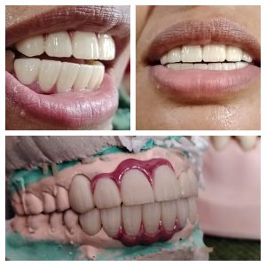 Zirconia smile Makeover